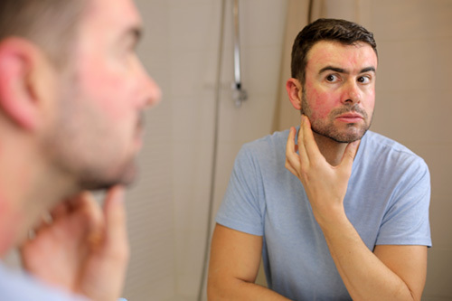 Man with rosacea checking out his symptoms in the mirror