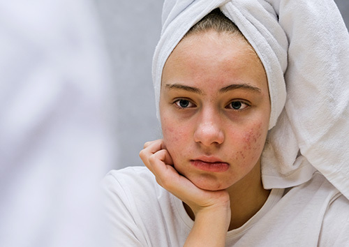 Depressed teen girl looking in the mirror at acne on her face