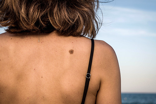 Woman with a mole on her back, possible skin cancer