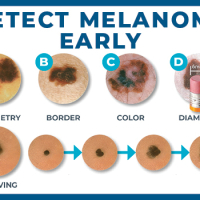 What Are The ABCDEs of Skin Cancer?