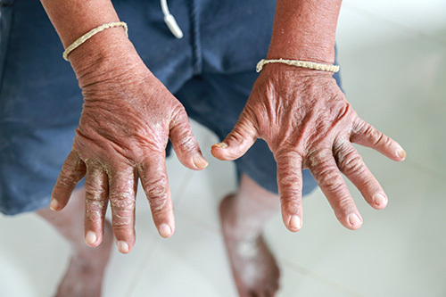 older adults' hands showing signs of scleroderma