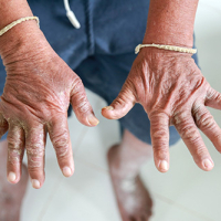 5 Things to Know About Scleroderma