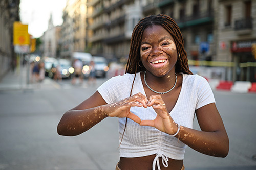 Young woman with vitiligo smiling